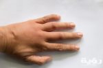 swollen and puffy hand scaled