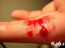 Bleeding finger scaled