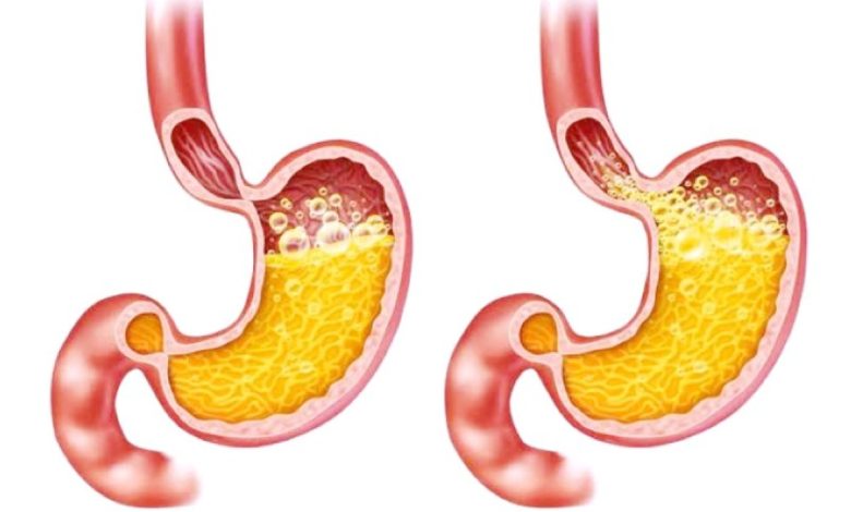 دراسة جديدة: ارتجاع المريء يزيد خطر الإصابة بالنوبات القلبية بنسبة 30%! 1 دراسة جديدة: ارتجاع المريء يزيد خطر الإصابة بالنوبات القلبية بنسبة 30%!